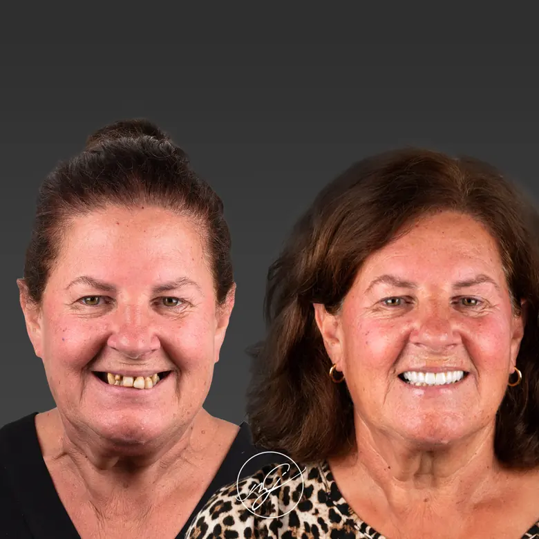 Caso clínico antes e depois — Implantes dentários · FP-1