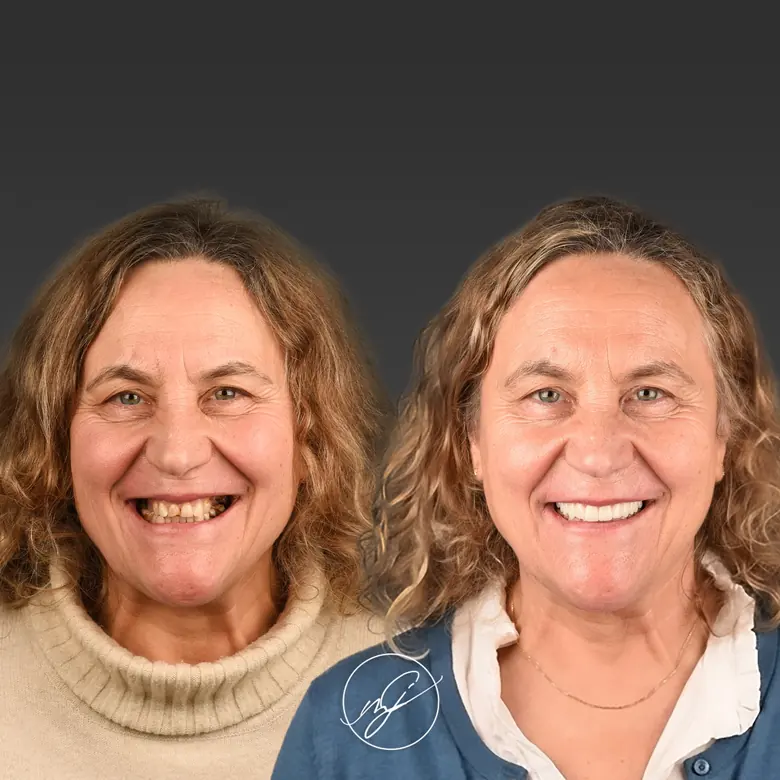 Caso clínico antes e depois — Facetas e implantes dentários
