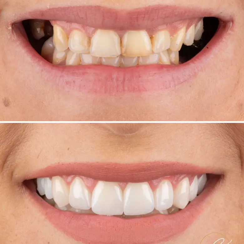 Caso clínico antes e depois — Facetas e implantes dentários