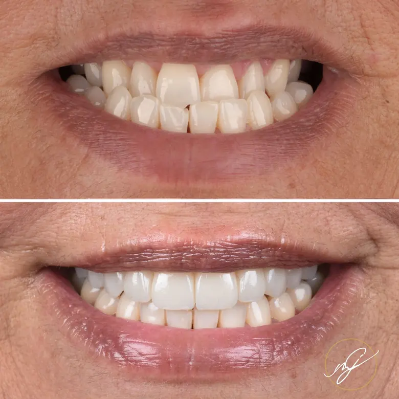 Caso clínico antes e depois — Facetas e implantes dentários