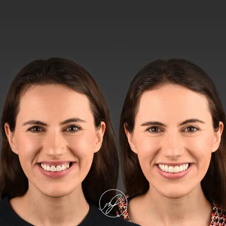 Caso clínico antes e depois — Facetas dentárias